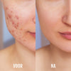 Acne behandelen met blauw en rood licht – ondersteunt het natuurlijke herstel van de huid
