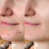SilkyPlanet DermaClear LED acne behandeling apparaat – veilige en effectieve huidverbetering met lichttherapie
