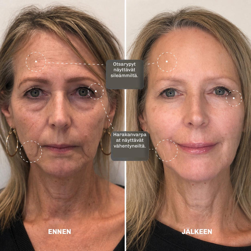 MicroLift Shot