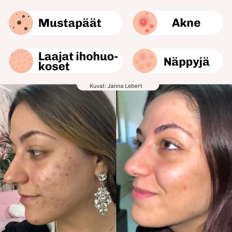 Peel-off-naamio mustapäille – levitetty kasvoille ennen kuivumista ja poistamista