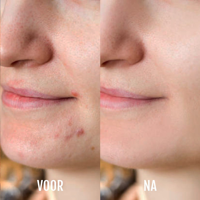 SilkyPlanet DermaClear LED acne behandeling apparaat – veilige en effectieve huidverbetering met lichttherapie