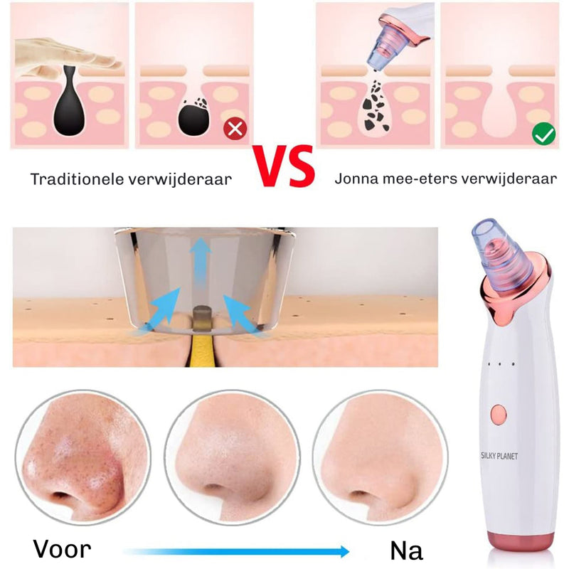 SilkyPlanet SkinClear 3 mee-eter verwijderaar apparaat – effectieve oplossing voor zwarte puntjes