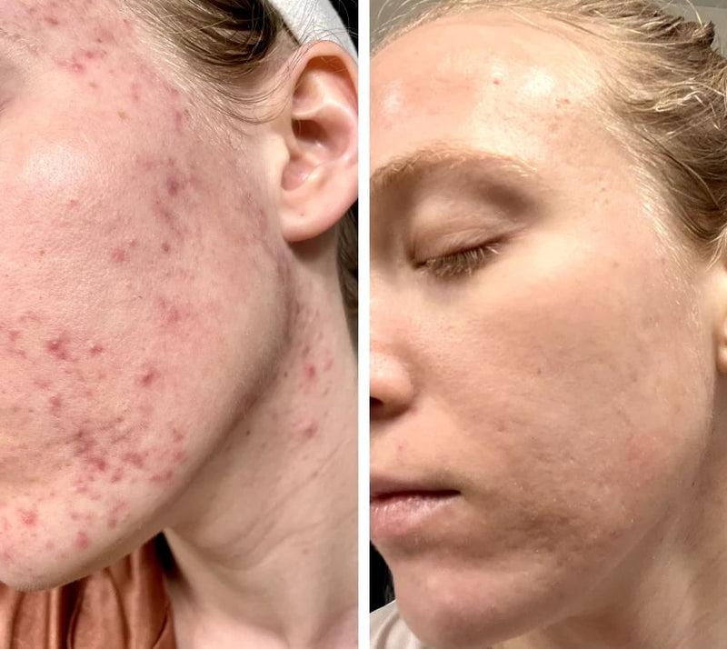 LED-valoterapia kasvonaamio