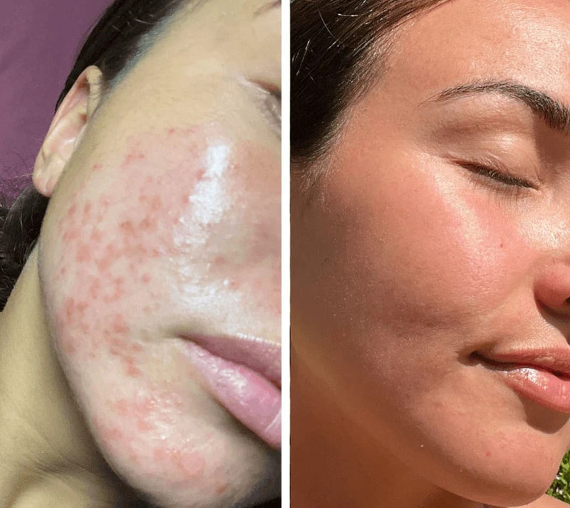 LED-valoterapia kasvonaamio