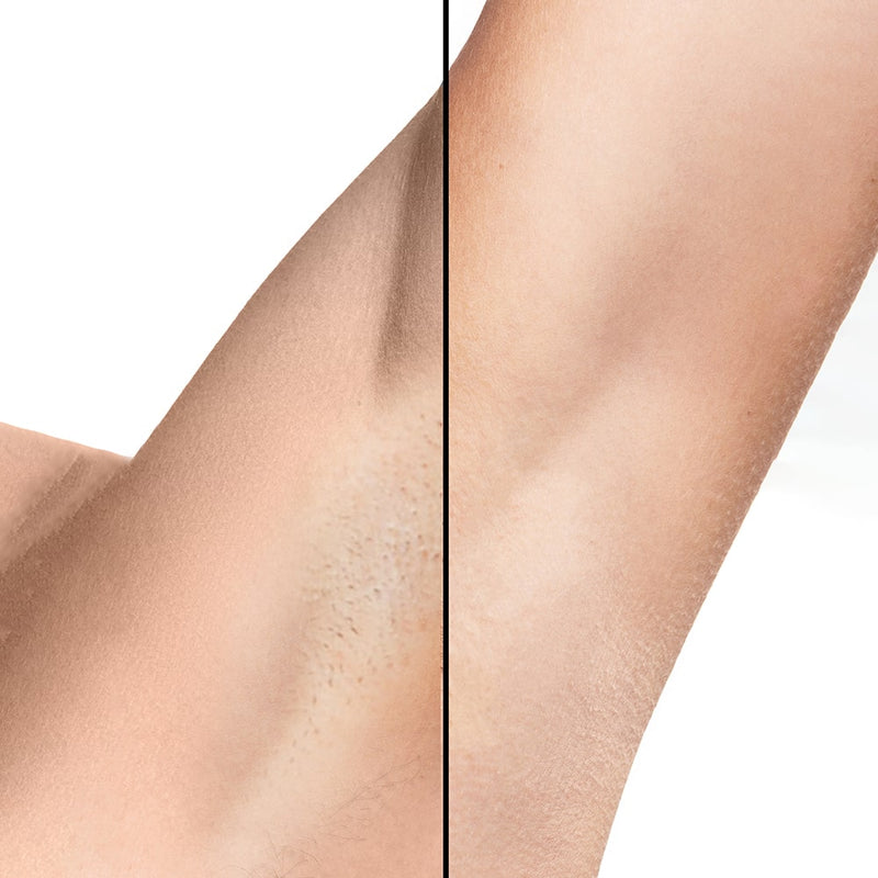 Lumi IPL karvojen poistolaite bikini-alueelle – tarkka ja hellävarainen karvanpoisto kotona